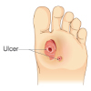 Diabetic Foot Ulcers