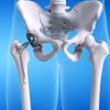 Hip Replacement