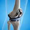 Knee Replacement