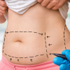 Liposuction