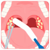 Tonsillectomy