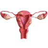 Uterine Fibroids